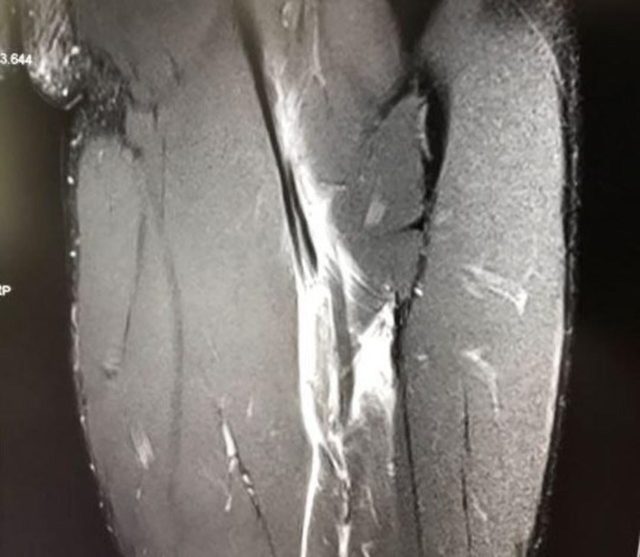 hamstring bolt